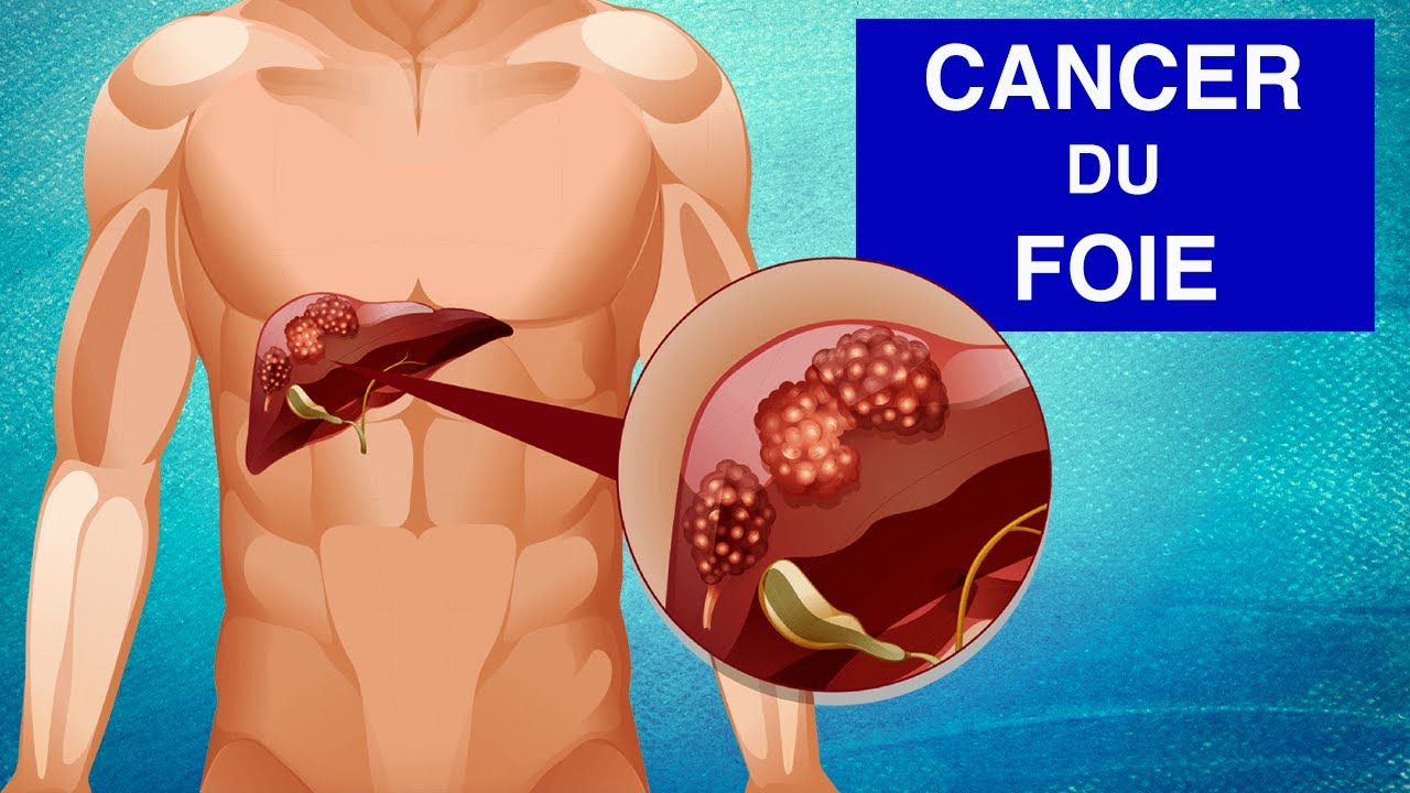 CANCER DU FOIE :  Symptômes et Traitements