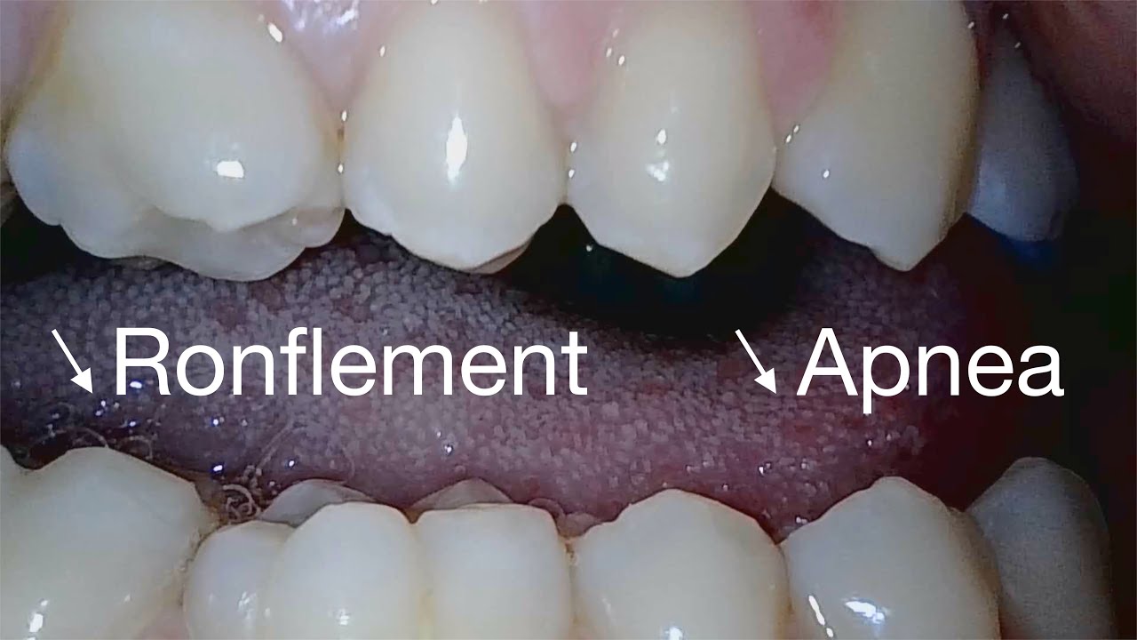 Ronflement et apnée du sommeil non dorsale: Comment les diminuer?