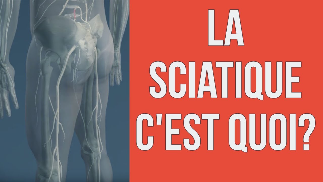Sciatique par hernie discale: c'est quoi, combien de temps ça dure & comment guérir?